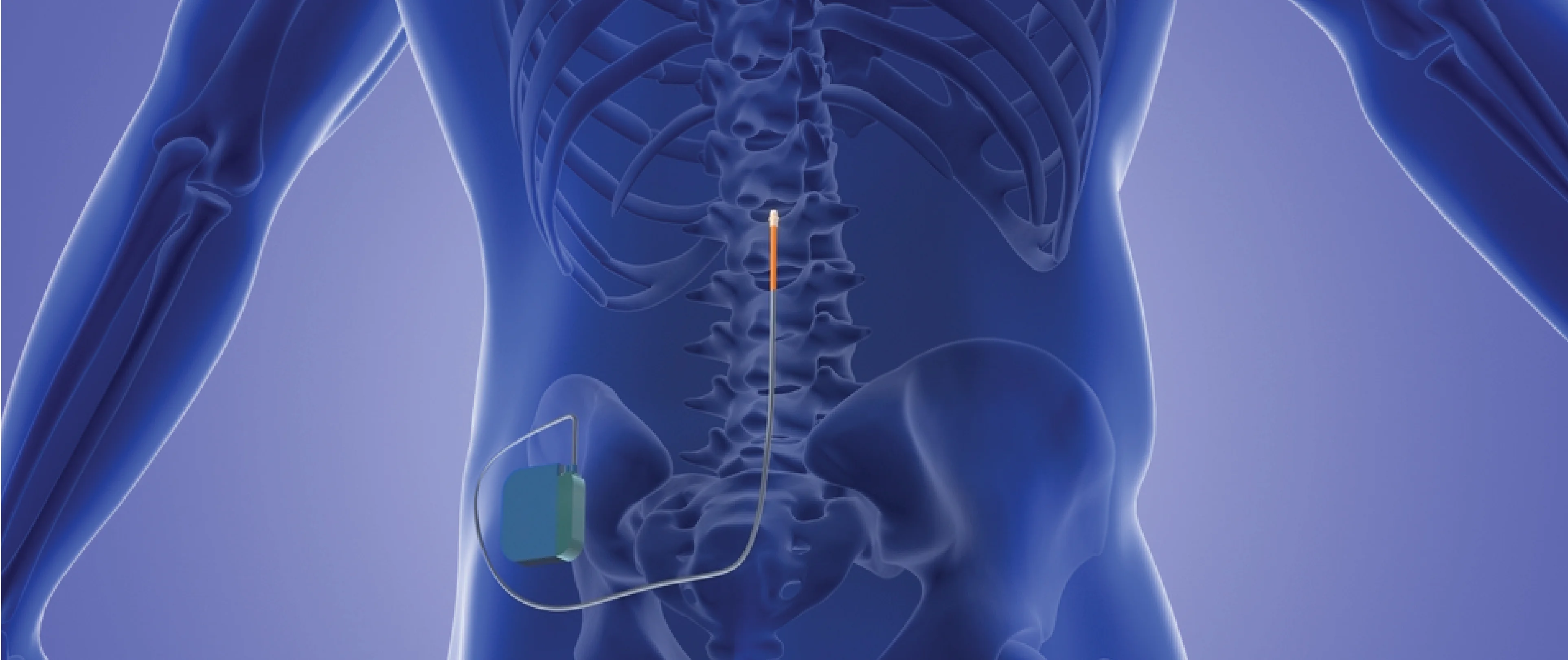 Epidural stimulation, spinal cord injury treatment